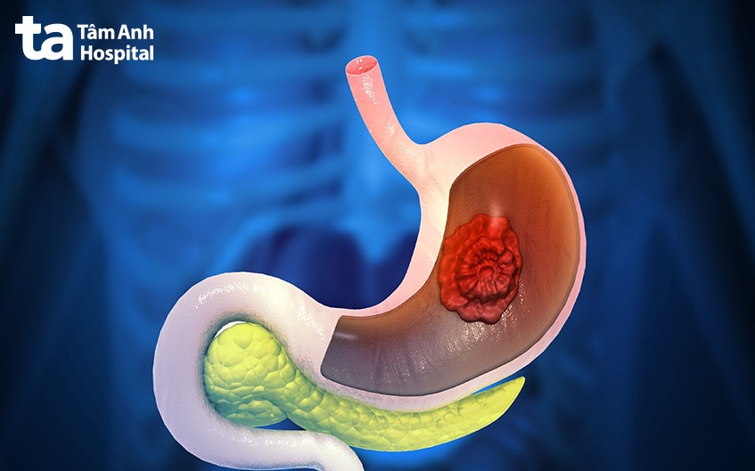 Dạ dày là gì? Cấu tạo, vị trí nằm ở đâu và cách chăm sóc