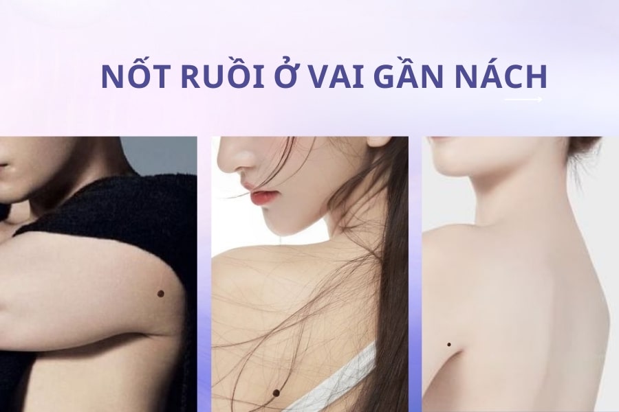 Nốt ruồi ở nách mang ý nghĩa tốt hay xấu? Có nên xóa không?