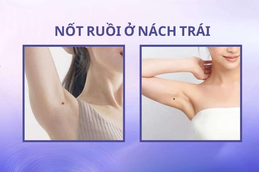 Nốt ruồi ở nách mang ý nghĩa tốt hay xấu? Có nên xóa không?