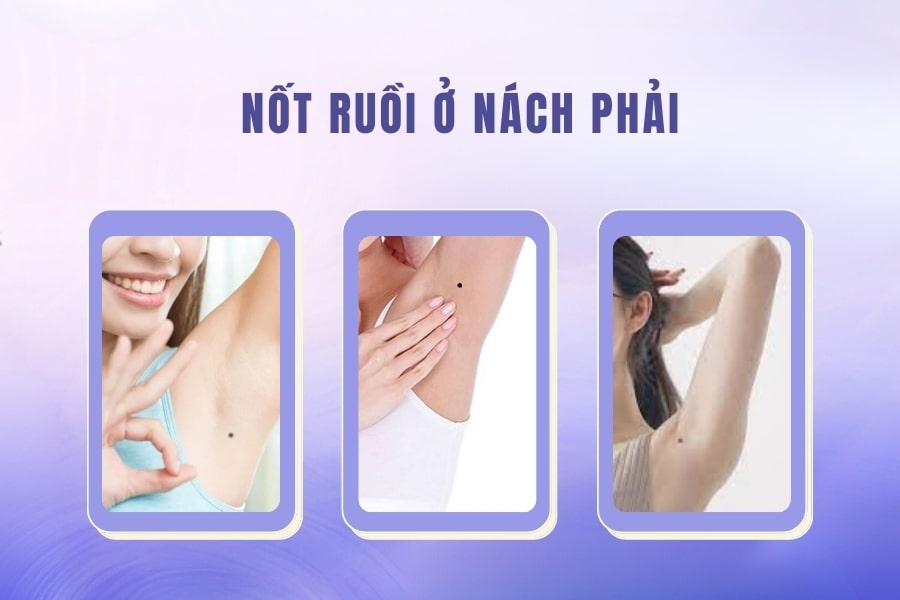 Nốt ruồi ở nách mang ý nghĩa tốt hay xấu? Có nên xóa không?